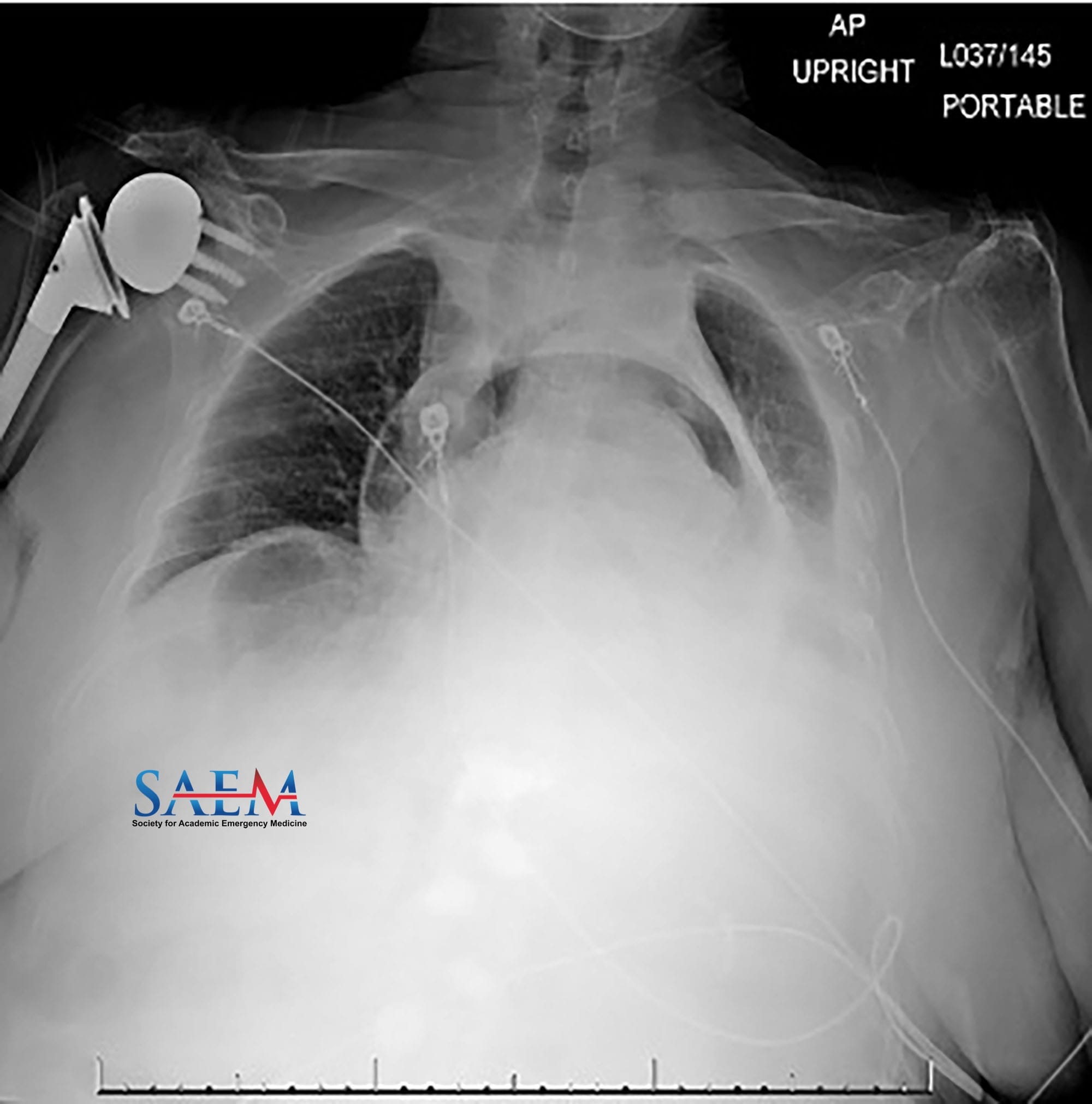 pneumopericarditis