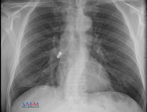 SAEM Clinical Images Series: I’m Plugged Up