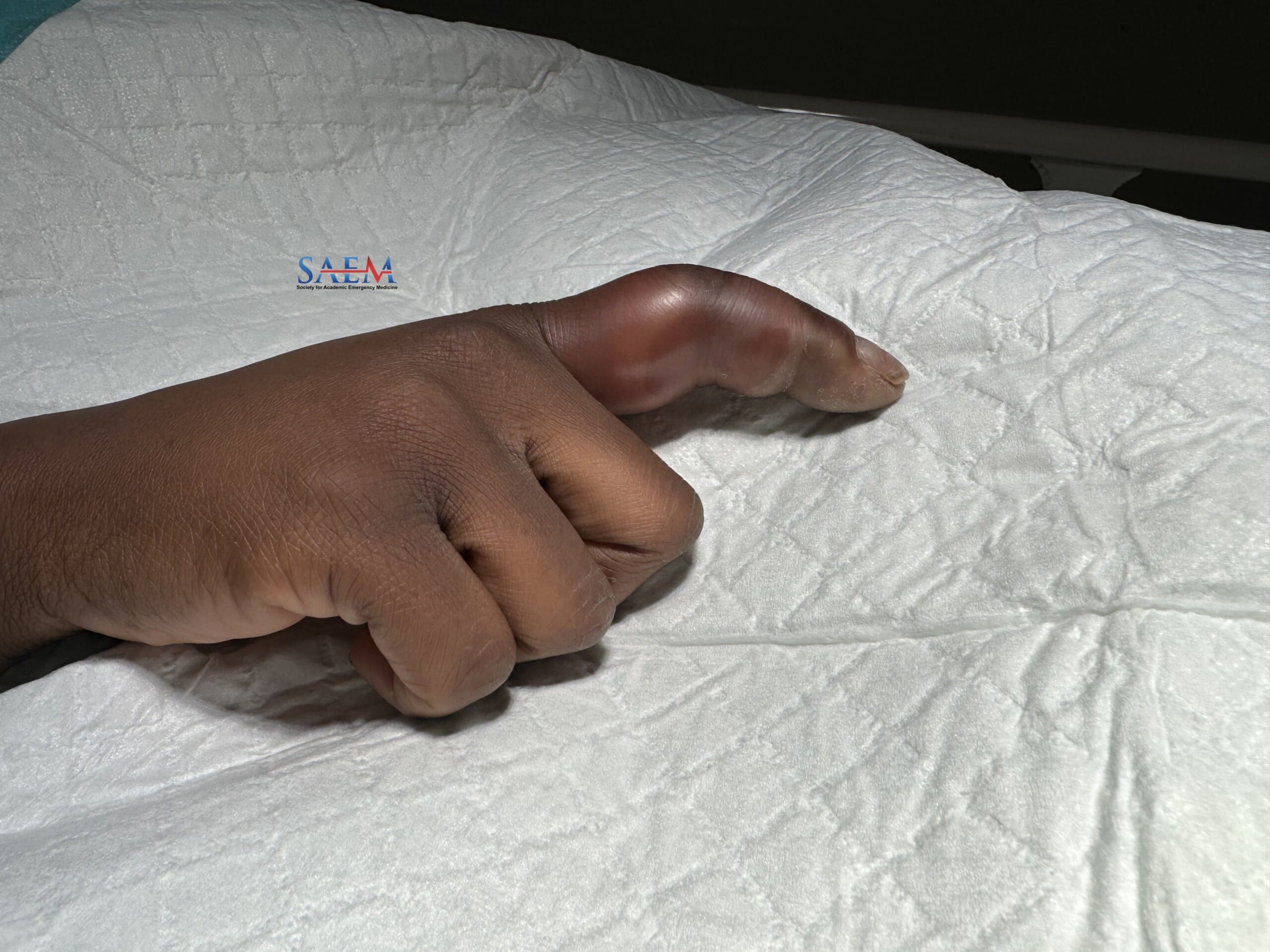tenosynovitis
