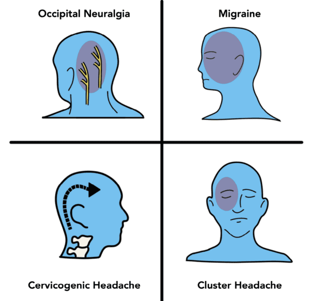GON headache types