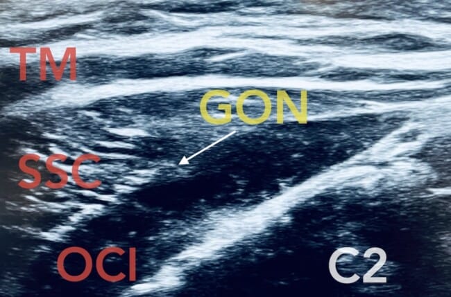 Greater occipital nerve block GON ultrasound anatomy