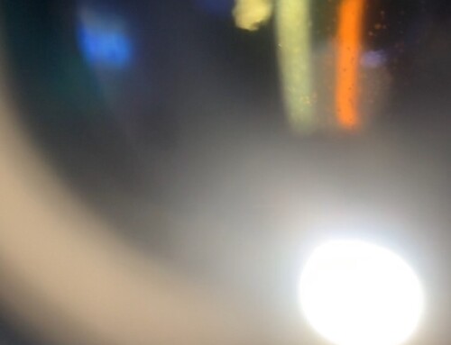 SAEM Clinical Images Series: I Cannot See My Rashes