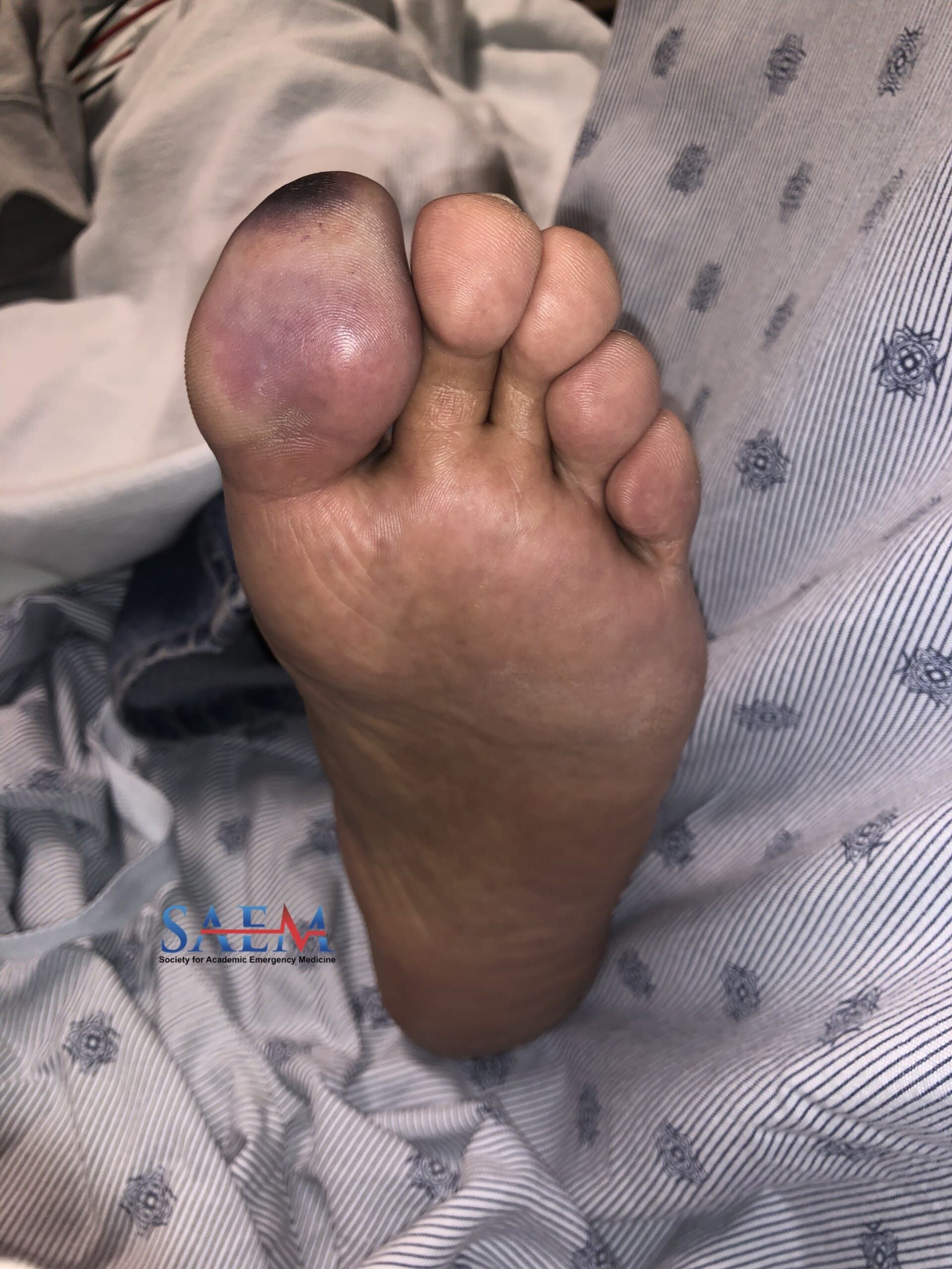 great toe