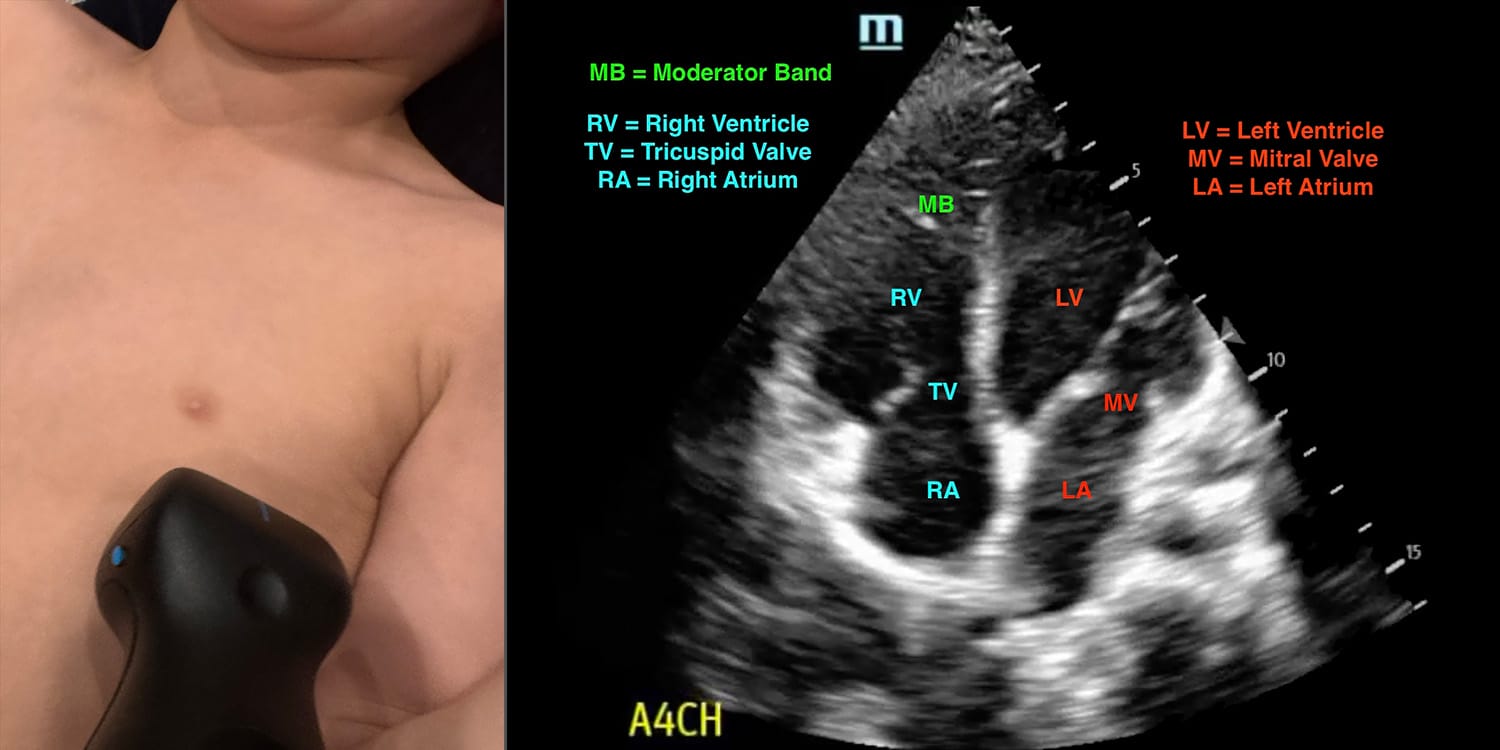 PEM POCUS Cardiac ultrasound apical 4 chamber A4CH view and probe placement