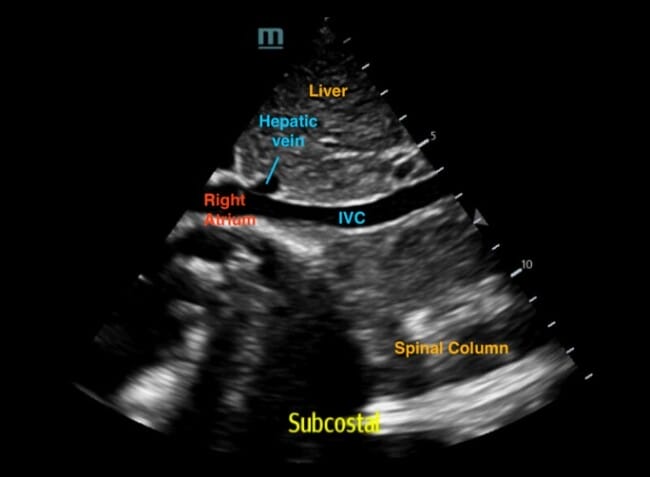 Figure 10 IVC sagittal view labelled