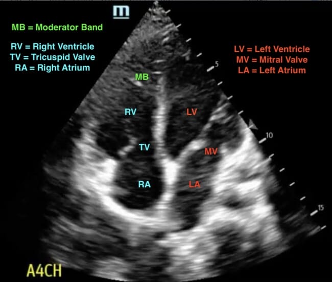 Normal A4CH view with labels