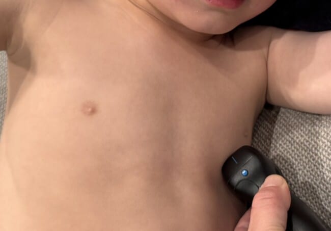 Figure 5 Probe placement A4CH left lateral decub