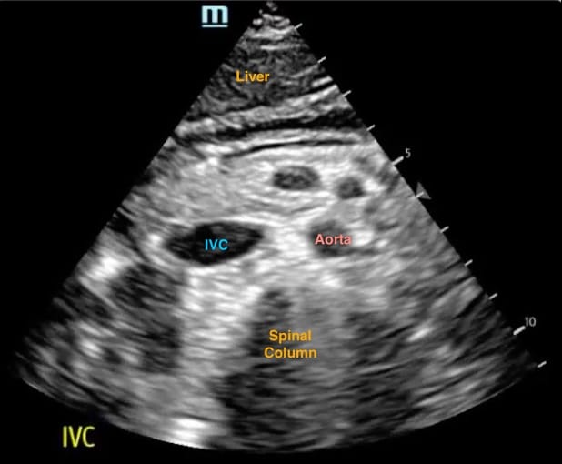 Figure 9. IVC transvere view with anatomy labels