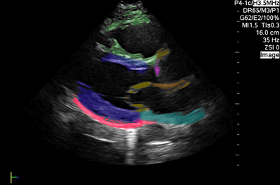 normal pediatric cardiac POCUS PSLA view