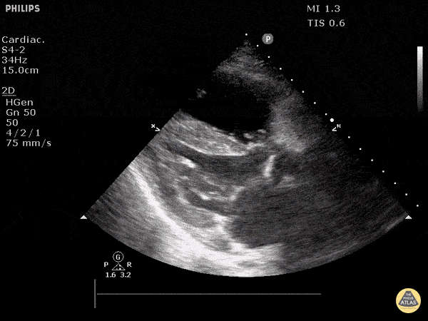 Video 26 RV dilation PSLA