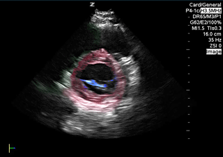 video normal PSSA view
