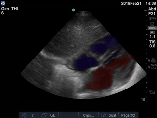 Video 7 SUBX view normal