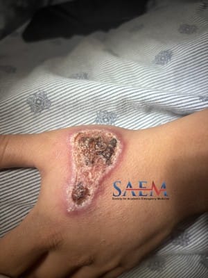 rash
