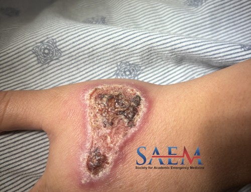 SAEM Clinical Images Series: Tropical Rash