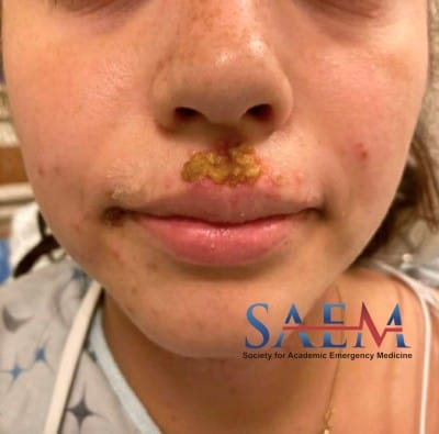 eczema