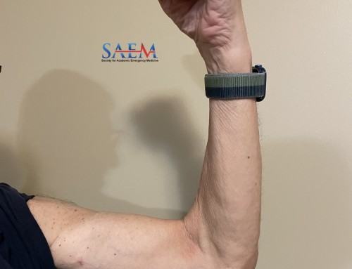 SAEM Clinical Images Series: A Case of Sudden Right Arm Pain and Deformity