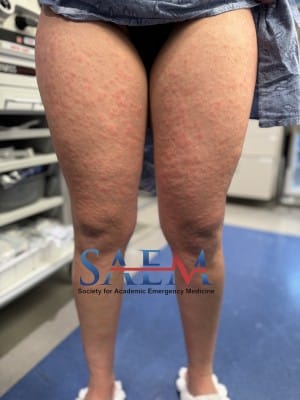 rash