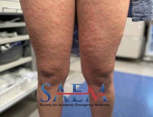 SAEM Clinical Images Series: First a Splash and then a Rash
