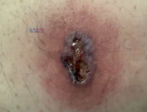 SAEM Clinical Images Series: Leg Rash