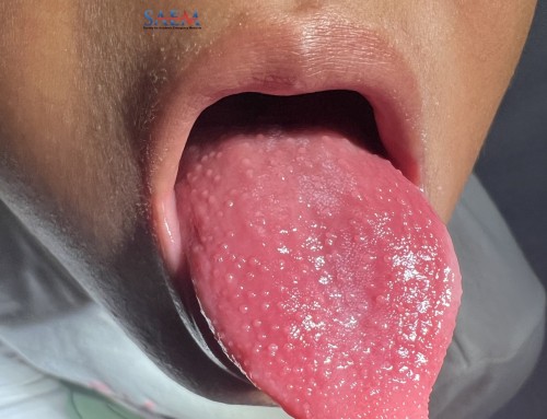 SAEM Clinical Images Series: Strawberry Tongue