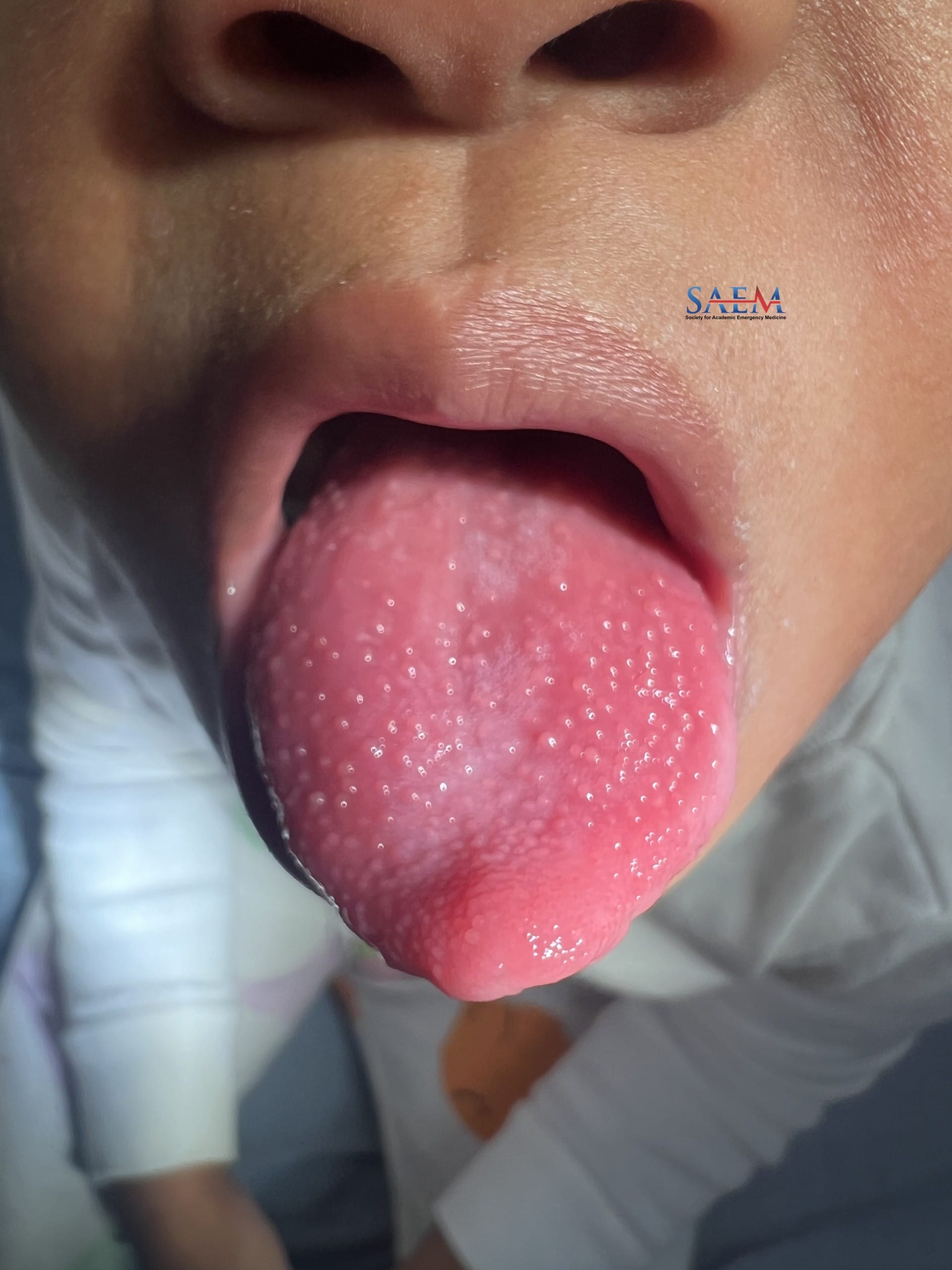 strawberry tongue