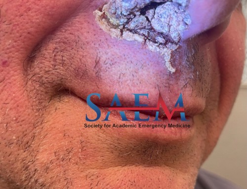 SAEM Clinical Images Series: No, I Am Not Diabetic!