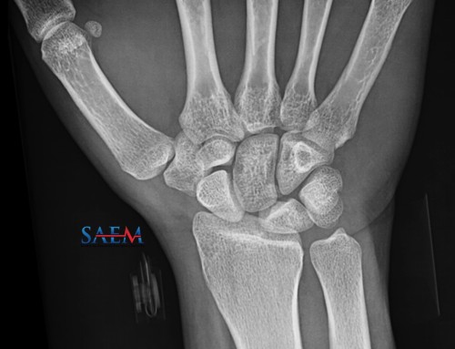 SAEM Clinical Images Series: Mind the Gap