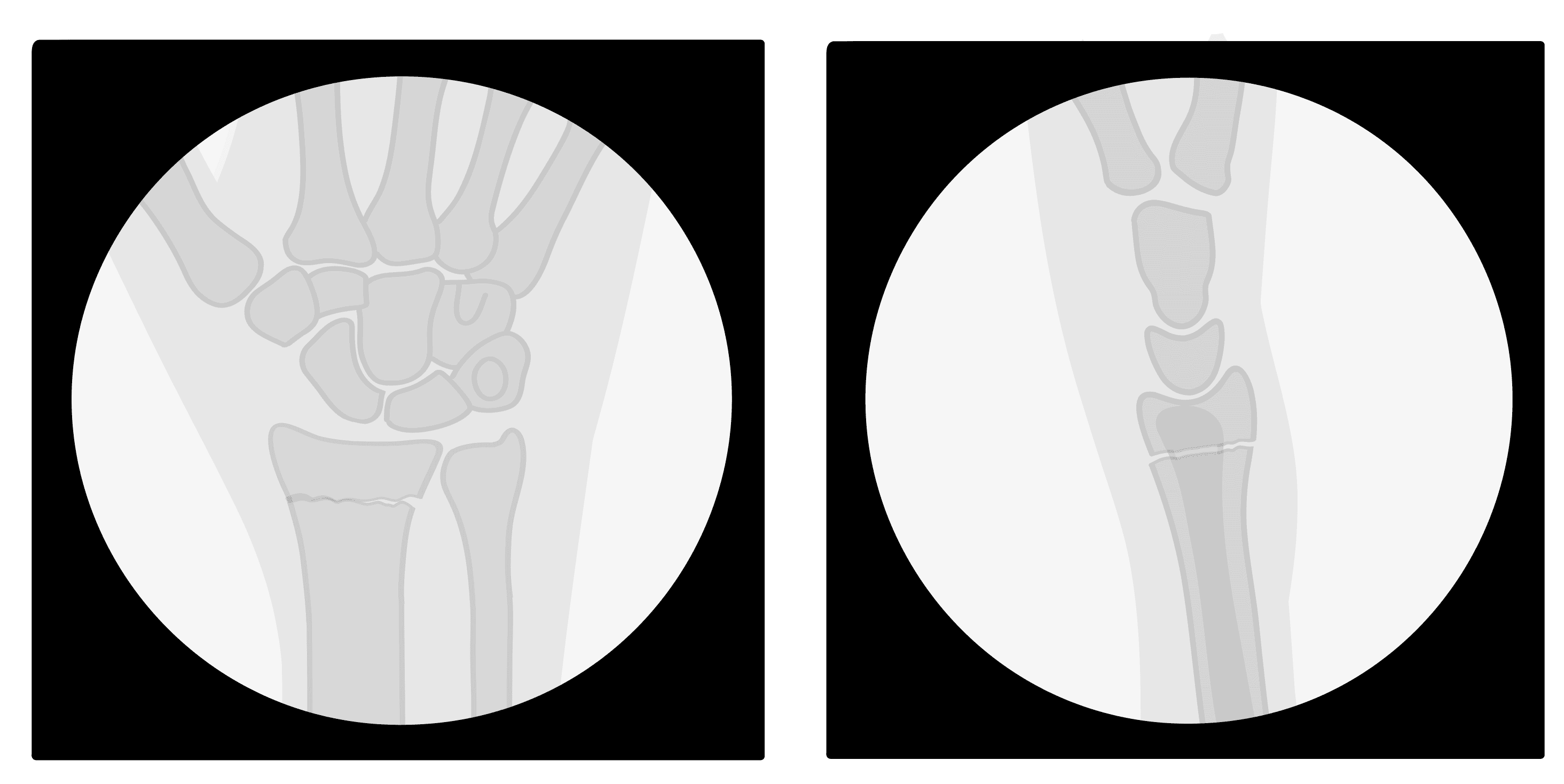 Illustrated mini C-arm images of a post-reduction distal radius fracture