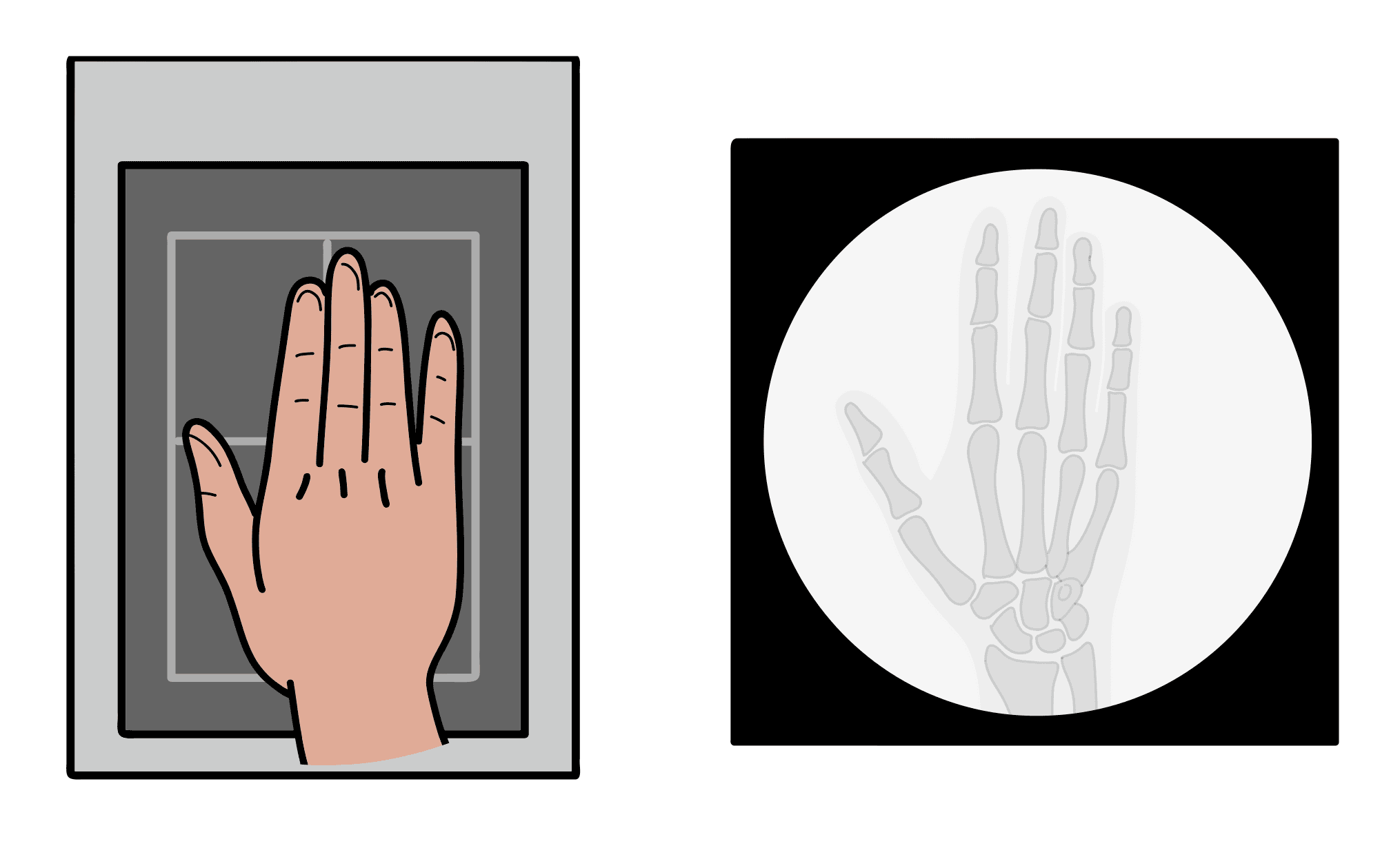 Illustrated mini C-arm image of hand in posteroanterior view.