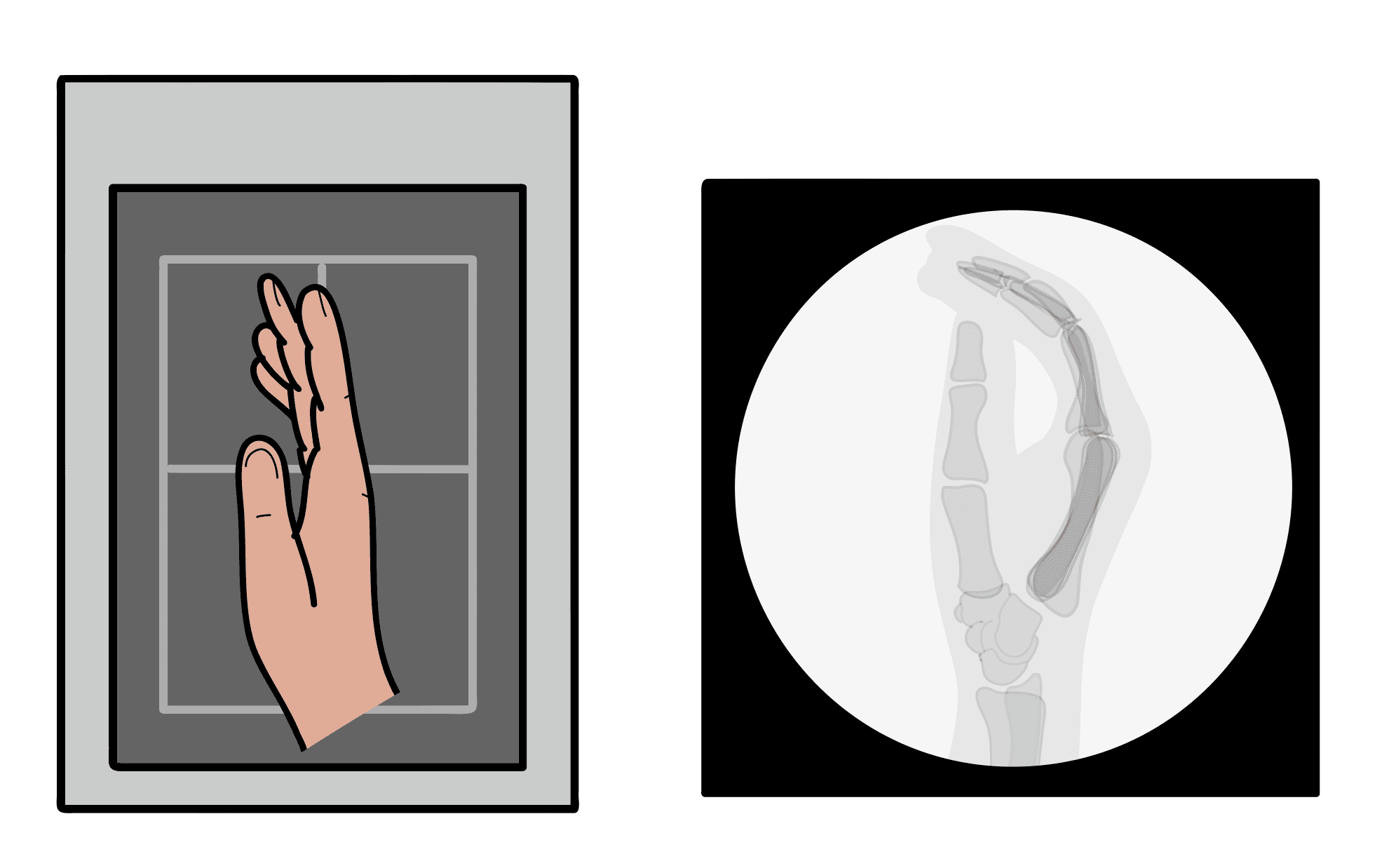 Illustrated mini C-arm image of hand in lateral view