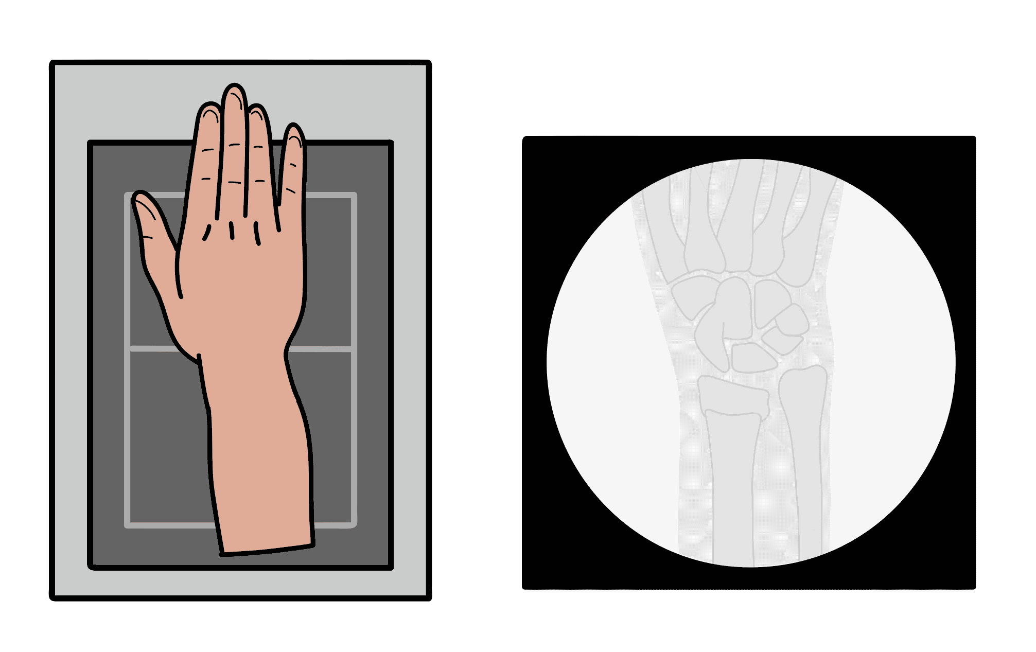 Illustrated mini C-arm image of a distal radius fracture in posteroanterior view