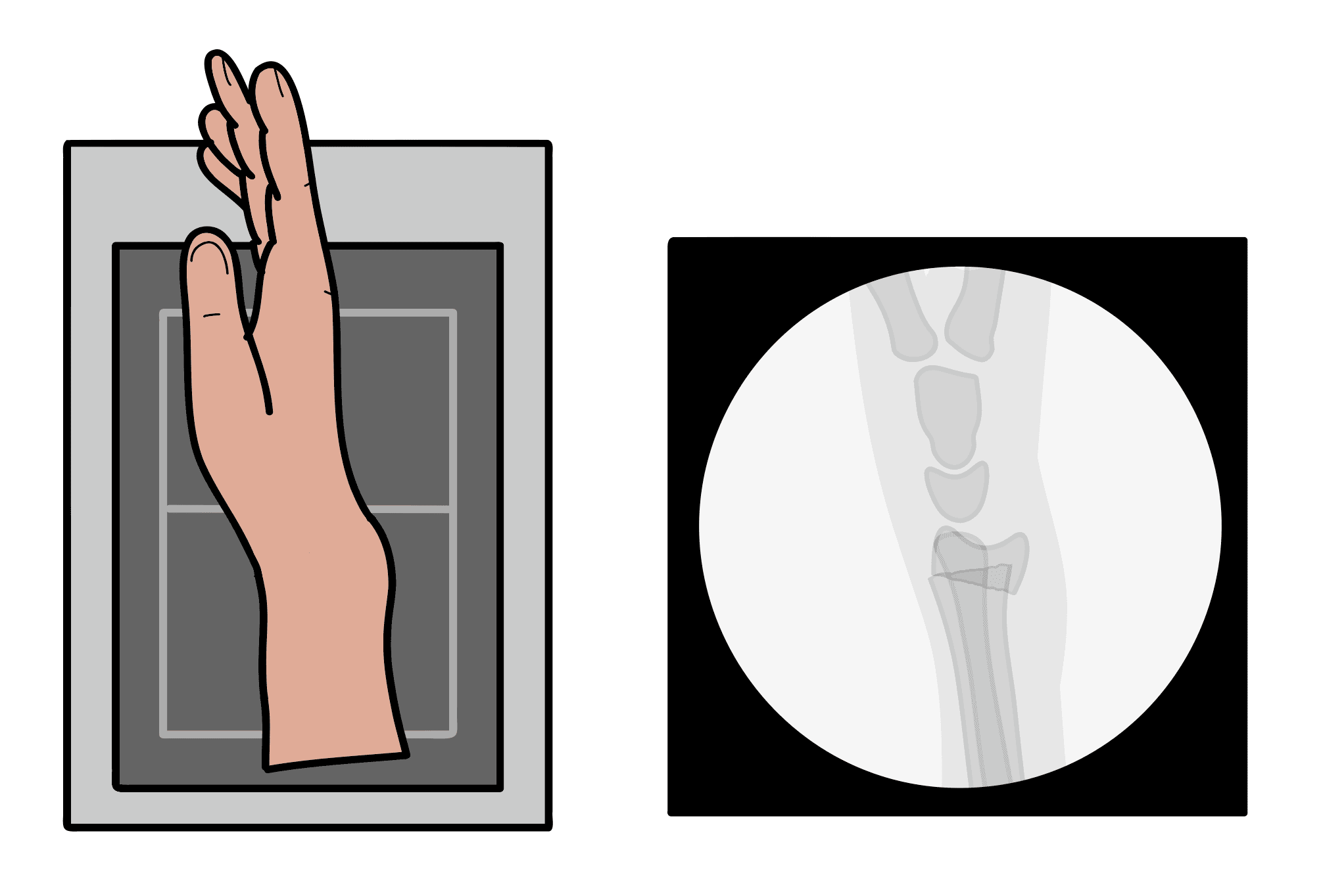 \Illustrated mini C-arm image of a distal radius fracture in lateral view
