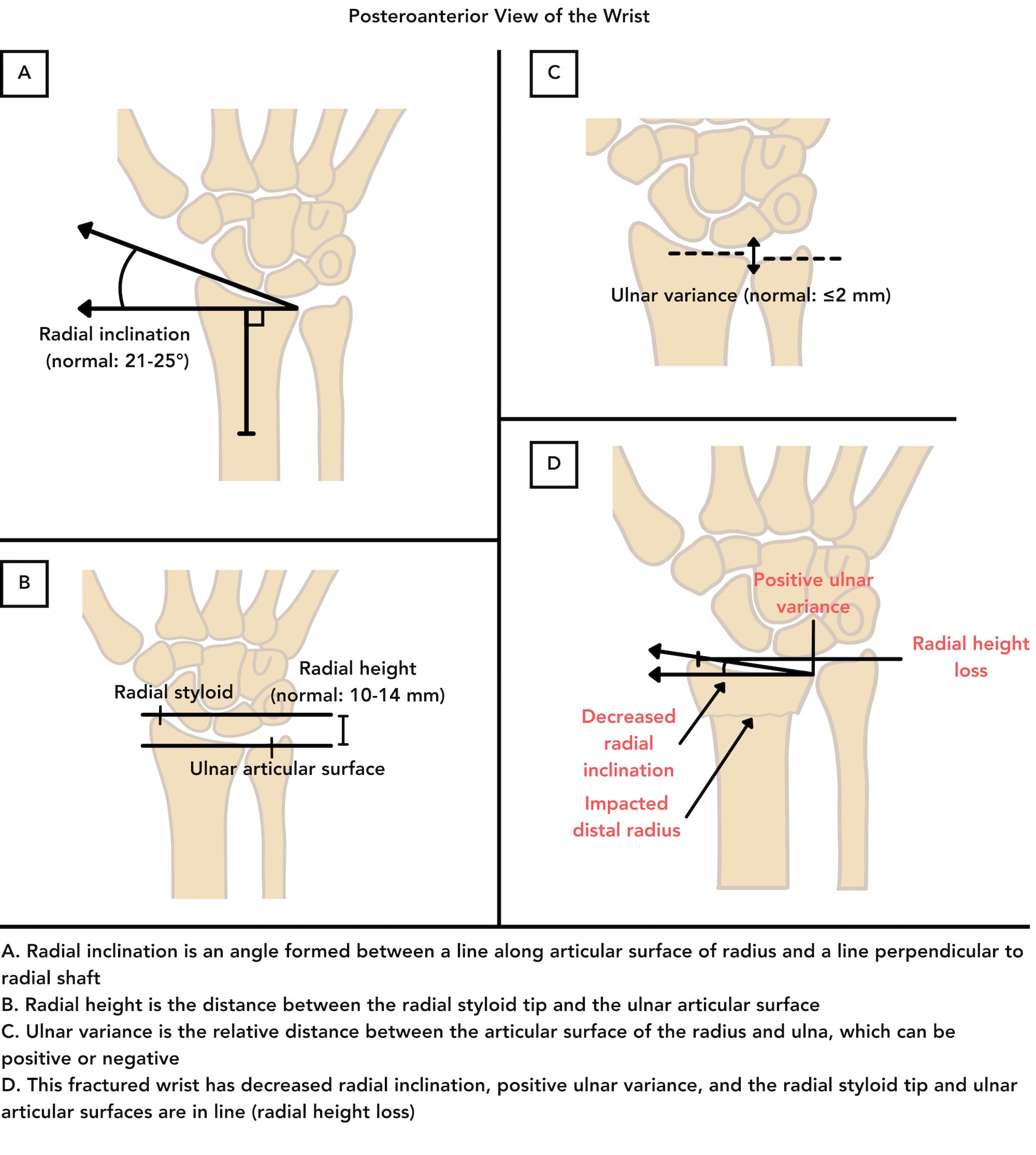 Measurements of the distal radius in posteroanterior view