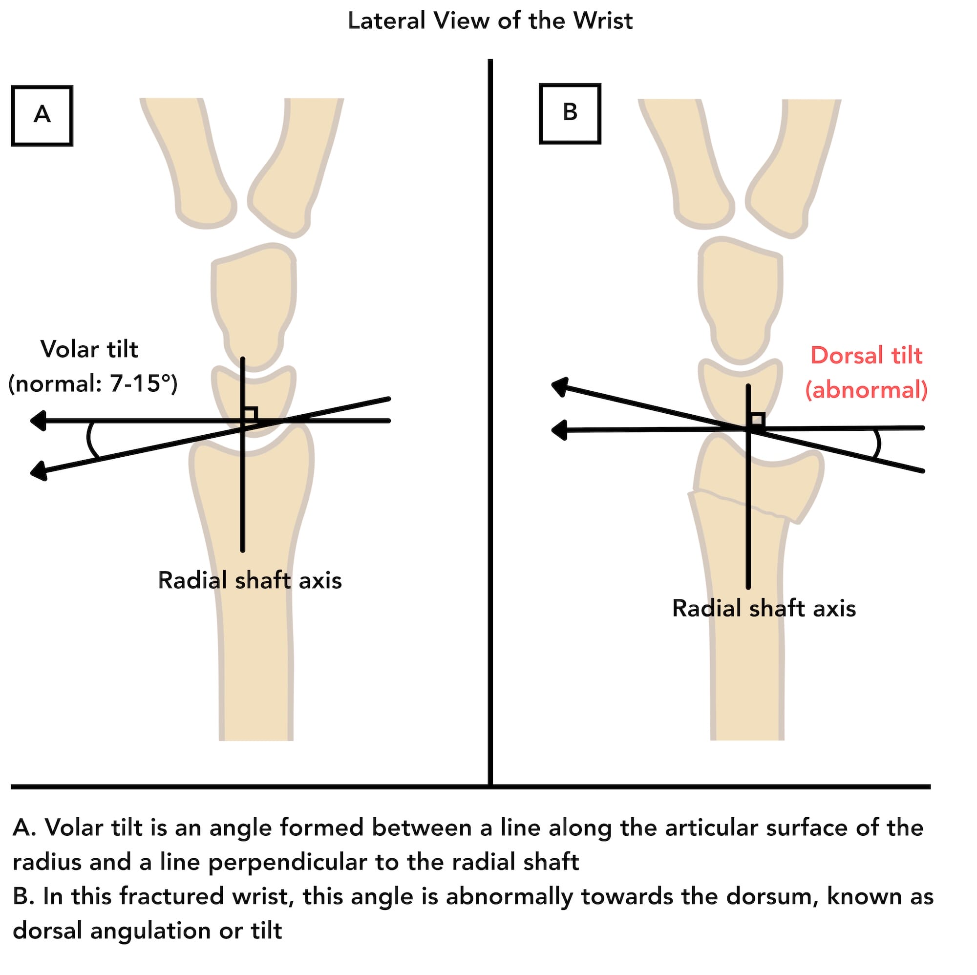 Measurements of the distal radius in lateral view