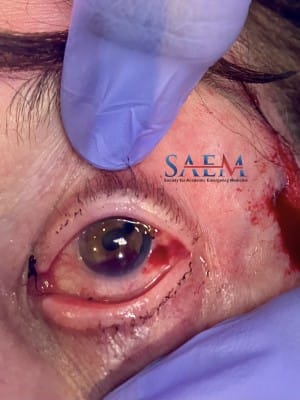 eye