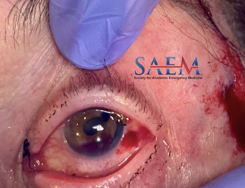 SAEM Clinical Images Series: Ocular Trauma Following Ground Level Fall