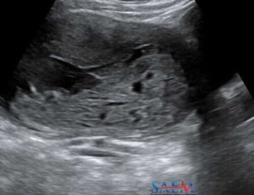SAEM Clinical Images Series: Bilateral Leg Swelling with a Uterine Twist