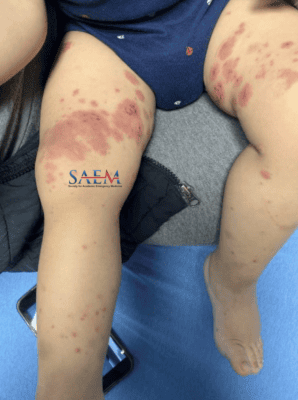 bruise