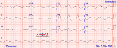 EKG