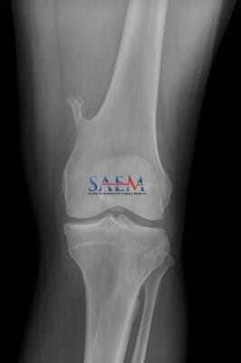 knee