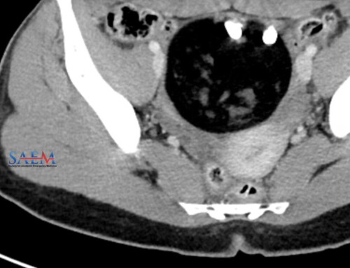 SAEM Clinical Images Series: A Curious Case of Abdominal Pain