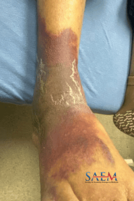 ecchymosis