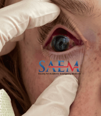 eye
