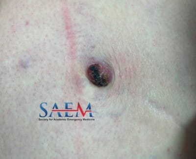 umbilicus