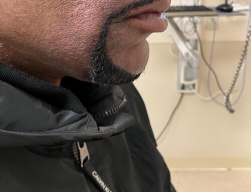 SAEM Clinical Images Series: Perioral Facial Swelling