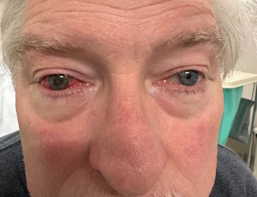 SAEM Clinical Images Series: Painful Red Eye