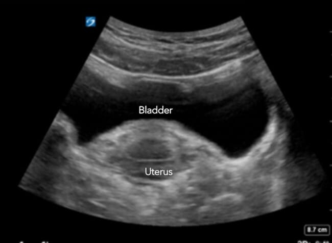 transabdominal view transverse