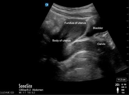 transabdominal longitudinal view pregnancy