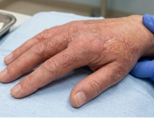 ACMT Toxicology Visual Pearl: Delayed Skin Burn