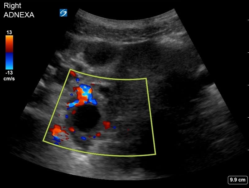 ring of fire ultrasound adnexa